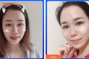 福州眼科醫(yī)院程金輝整形價格表附眼部手術案例展示