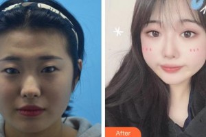 福州眼科醫(yī)院胡穎峰整形價格表附眼部整形案例展示