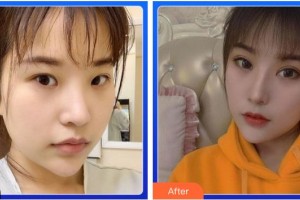 福州眼科醫(yī)院吳景華整形價(jià)格表附眼部綜合案例展示