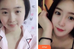 福州眼科醫(yī)院王艷整形價(jià)格表附眼部整形案例展示