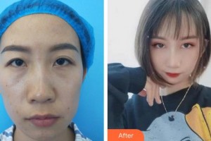 福州眼科醫(yī)院莊雪梅整形價(jià)格表附眼部整形案例展示