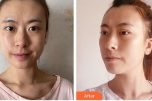 福州眼科醫(yī)院黃春艷整形價(jià)格表附切開(kāi)雙眼皮案例展示