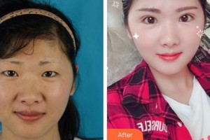 福州東南眼科醫(yī)院劉利娟整形價(jià)格表附切開(kāi)雙眼皮案例展示