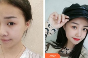 福州東南眼科醫(yī)院楊蘊華整形價格表附眼部手術(shù)案例展示