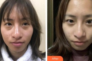 福州東南眼科醫(yī)院夏江勝整形價格表附不開刀去眼袋+淚溝填充案例展示