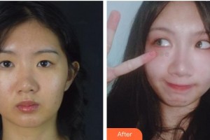 福州眼科醫(yī)院陳永和整形價格表附雙眼皮案例展示