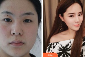 福州眼科醫(yī)院陳迎月整形價格表附眼部整形案例展示