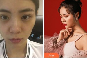 福州東南眼科醫(yī)院吳欽玲整形價格表附雙眼皮修復(fù)案例展示