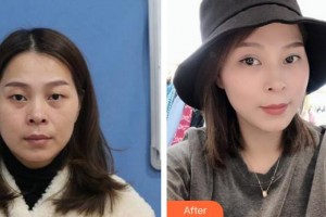 福州東南眼科醫(yī)院高文星整形價(jià)格表附上瞼微整案例展示