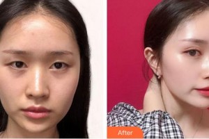 福州東南眼科醫(yī)院房鑫鑫整形價(jià)格表附眼部矯正案例展示