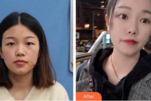 福州東南眼科醫(yī)院魏金鑫整形價(jià)格表附雙眼皮案例展示