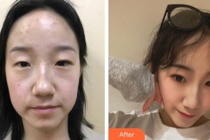 福州東南眼科醫(yī)院歐麗萍整形價格表附雙眼皮案例展示