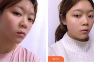 福州東南眼科醫(yī)院王燕蘭整形價(jià)格表附雙眼皮案例展示