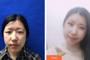 福州東南眼科醫(yī)院朱銳整形價(jià)格表附美眼案例展示