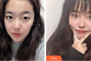 福州東南眼科醫(yī)院李仲整形價(jià)格表附雙眼皮案例展示