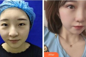 福州東南眼科醫(yī)院鄭文整形價格表附雙眼皮案例展示