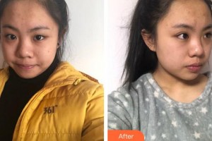 福州東南眼科醫(yī)院林寶仁整形價格表附眼部案例展示