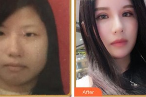 福州東南眼科醫(yī)院童繹整形價(jià)格表附眼部整形案例展示