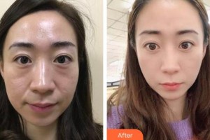 福州東南眼科醫(yī)院李圣請(qǐng)整形價(jià)格表附不開刀去眼袋+淚溝填充案例展示