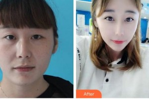 福州東南眼科醫(yī)院王秉農(nóng)整形價(jià)格表附眼部手術(shù)案例展示