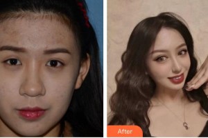 福州東南眼科醫(yī)院程潔整形價(jià)格表附切開雙眼皮案例展示