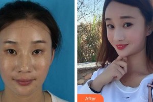 福州東南眼科醫(yī)院伏冰冰整形價(jià)格表附切開雙眼皮案例展示