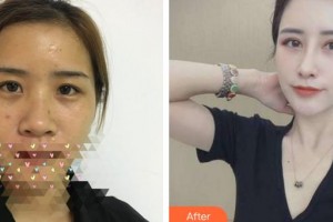 福州東南眼科醫(yī)院陳元整形價(jià)格表附眼部手術(shù)、鼻部手術(shù)，多方面部脂肪填充案例展示