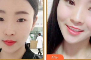 福州東南眼科醫(yī)院劉秀珍整形價(jià)格表附眼部修復(fù)案例展示