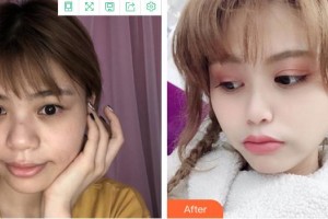 福州東南眼科醫(yī)院曾勍整形價(jià)格表附靈動(dòng)美眼案例展示