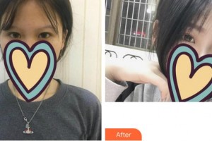 福州東南眼科醫(yī)院于麟整形價(jià)格表附get新技能較強(qiáng)眼妝眼部手術(shù)案例展示