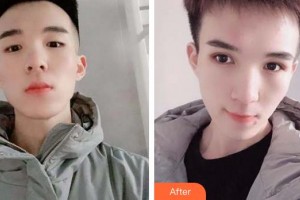 福州東南眼科醫(yī)院謝建明整形價(jià)格表附5s重瞼術(shù)+超微創(chuàng)開(kāi)內(nèi)眥案例展示