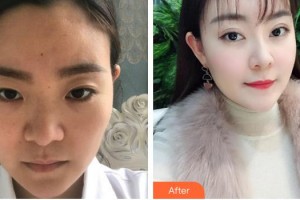 福州東南眼科醫(yī)院謝威義整形價(jià)格表附眼部手術(shù)案例展示