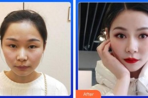 福州東南眼科醫(yī)院肖國(guó)武整形價(jià)格表附5s重瞼術(shù)+超微創(chuàng)開(kāi)內(nèi)眥案例展示