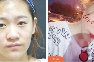 福州東南眼科醫(yī)院黃可進(jìn)整形價(jià)格表附成為雙眼皮女孩-雙眼皮案例展示