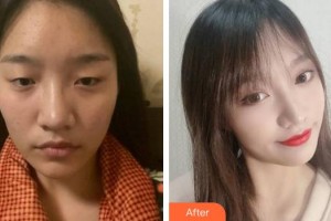 福州東南眼科醫(yī)院陳正勇整形價(jià)格表附眼部整形案例展示