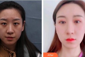 福州東南眼科醫(yī)院吳國(guó)瑋整形價(jià)格表附埋線(xiàn)重瞼修復(fù)+內(nèi)眥開(kāi)大術(shù)案例展示