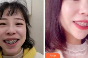 福州維樂(lè)口腔門(mén)診部陳獻(xiàn)禮整形價(jià)格表附牙綜合案例展示