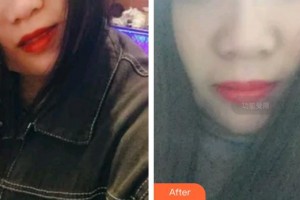 福州三顆牙口腔門(mén)診部鐘韋韋整形價(jià)格表附超聲波潔牙案例展示