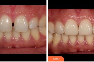 福州弗麗嘉口腔門(mén)診部陳輝整形價(jià)格表附牙齒貼面案例展示