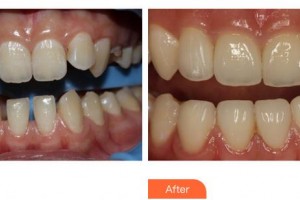 福州同福醫(yī)口腔門(mén)診部鄭曉玲整形價(jià)格表附牙齒貼面案例展示