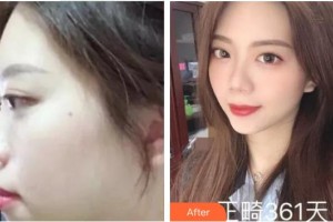 福州三顆牙口腔門診部許積紅整形價格表附骨性齙牙妹氣質(zhì)UPUPUP案例展示