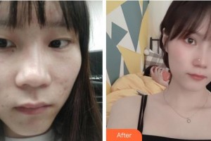 福州東南眼科醫(yī)院陳建明整形價格表附眼部整形案例展示