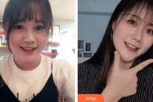 福州東南口腔醫(yī)院孔楊整形價格表附金屬托槽矯正案例展示