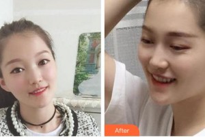 福州科爾口腔門診部劉斌元整形價格表附金屬托槽矯正案例展示