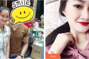 福州東南眼科醫(yī)院張智勇整形價格表附做雙眼皮真的是超棒的投資案例展示