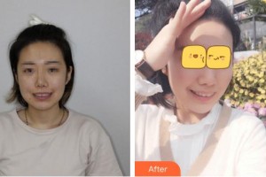 福州同福醫(yī)口腔門診部何鐘強整形價格表附瓷貼面日記案例展示