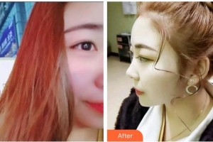 福州維樂口腔門診部許長記整形價格表附超聲波潔牙案例展示