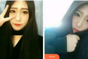 福州維樂(lè)口腔門(mén)診部林錦整形價(jià)格表附牙齒隱形矯正案例展示