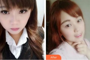 福州美可普口腔門診部劉杰整形價(jià)格表附牙齒隱形矯正案例展示