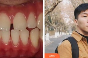 福州科爾口腔門診部阮旭杰整形價(jià)格表附金屬托槽矯正案例展示